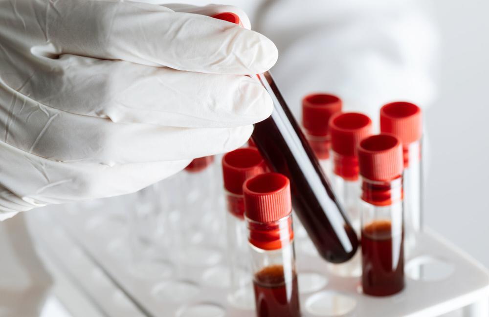 Para Ahli Menerbitkan Rekomendasi untuk Menangani Viral Load HIV yang Rendah tetapi Masih Terdeteksi